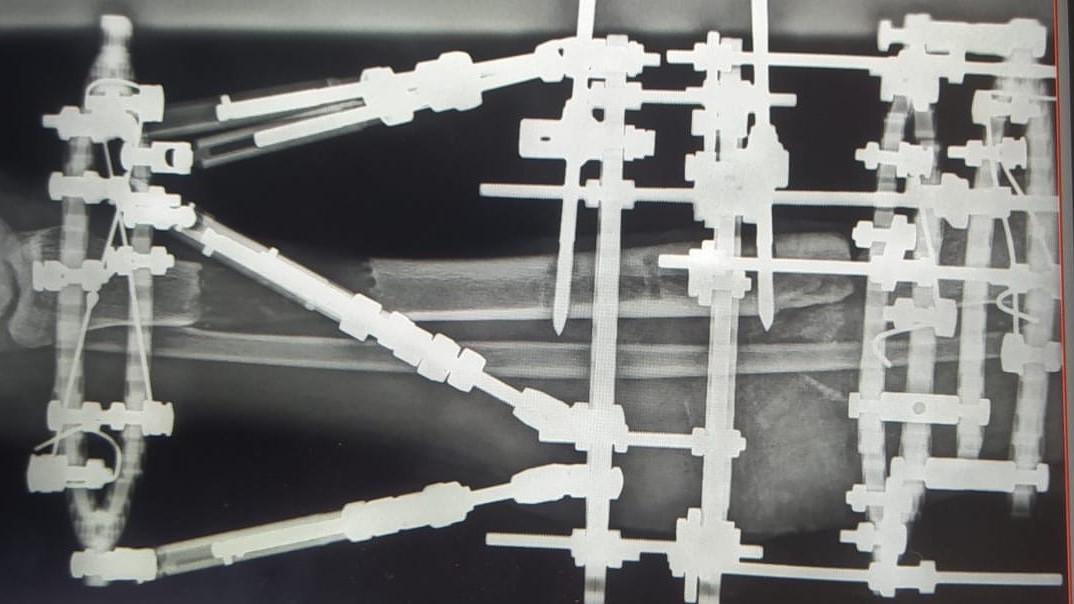 X-ray of a fractured lower limb with ilizarov frame